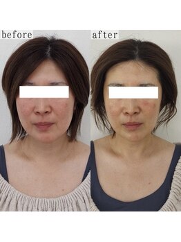 ヴェルシック(Belchic)/オプションで美白と保湿も叶う