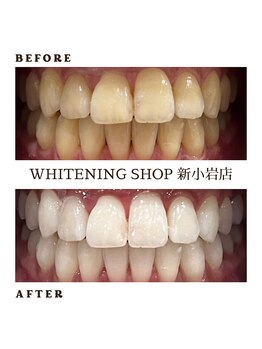ホワイトニングショップ 新小岩店/ホワイトニングBeforeAfter