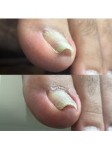 リリ(lili)/巻き爪矯正/5回目