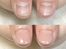 グラシナ なんば店/深爪/自爪育成/フィルイン