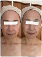 ジフィー(Gify)/筋膜リリースカッターFacial