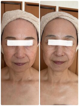 ジフィー(Gify)/筋膜リリースカッターFacial