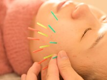 アロエベル(aloe Belle)/美容鍼