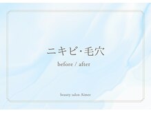 エイミー(Aimee)/ポテンツァ×ハーブピーリング