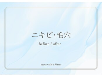 エイミー(Aimee)/ポテンツァ×ハーブピーリング