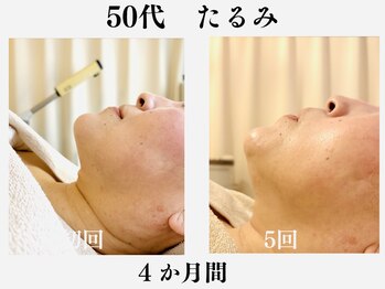 ランティル(l’until)の写真/たるみ/フェイスライン/アゴ下もたつきに/脂肪分解剤と小顔リフトアップマッサージでお顔一回り小さく!