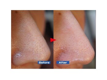 ハーシークレット(Her secret)/ハイドラ毛穴洗浄