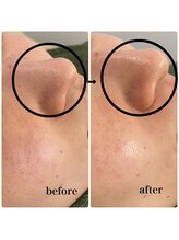 ラシック(Rachic)/ハーブピーリング