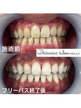 ホワイトニングサロン 京都烏丸店/ホワイトニングサロン施術例