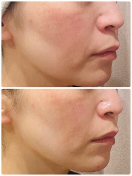 アメリオレ(ameliorer)/αIPLUS 光フェイシャル