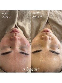 エヌボーテ(n beaute)/HERMOSA/ハーブピーリング