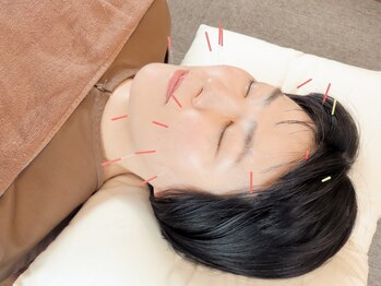 エド鍼灸治療院(EDO鍼灸治療院)の写真/眼精疲労には美容鍼灸が効果的！目の周り・頭・首のツボを刺激し、血流アップで目の疲れをスッキリ解消！