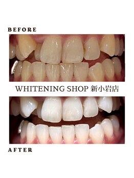 ホワイトニングショップ 新小岩店/ホワイトニングBeforeAfter