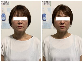 ロメリア(Roemeria)/お客様BeforeAfter