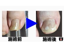 立川巻爪補正院/巻き爪補正　術前・術後