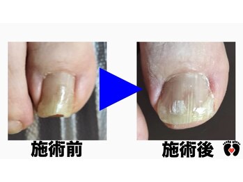 立川巻爪補正院/巻き爪補正 術前・術後