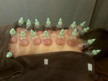 京 鍼灸院 整体院の雰囲気（ カッピングで血流と代謝を促して体の奥からスッキリ整える）