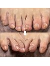 小指のお爪トラブルもスッキリ!