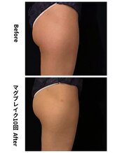 ラ セルフィー(Ra Selfee)/マグブレイク症例