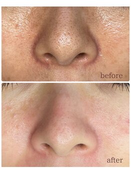 ミハン ボーテ(mihan.beaute)/【毛穴ひらき・くすみ】