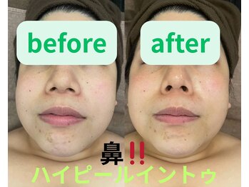 リラクゼーションサロン ラキ(laki)/ハイピールイントゥ/ピーリング