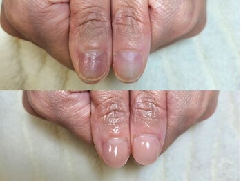 グラシナ なんば店/深爪/自爪育成/フィルイン