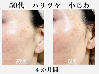 ランティル(l’until)の写真/40代50代シミ/くすみ/小じわをケアしてハリツヤを!理想の自分に出会う【ララピール】で素肌が輝く♪