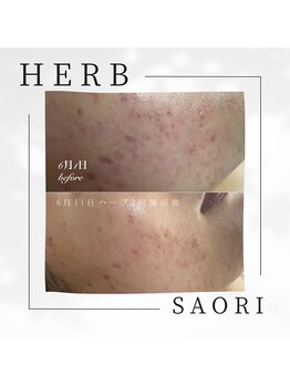 ハナスイ(HANASUI)/お肌悩みはコレ♪