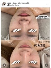 ジョワ 黒崎店(joie)/肌革命ハーブピーリング