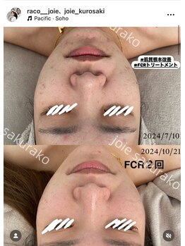 ジョワ 黒崎店(joie)/肌革命ハーブピーリング