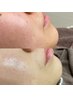 【W脱毛】WAX×光の相乗効果で効果最大！維持期間最長☆お顔の産毛撲徹宣言！