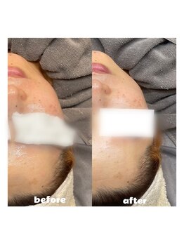 プティジョナ(Petit Jona)/◇顔wax＋光フェイシャル◇