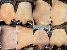 ライフサロン 天神(Life Salon)の雰囲気（ブツブツニキビケア◎背中ハーブピーリング☆Before /After）