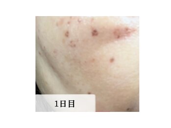 ラビエス(LAVIES)/シミケア施術１日目