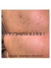 サロンドオフ 西梅田(salon de off)/肌質のビフォーアフター*