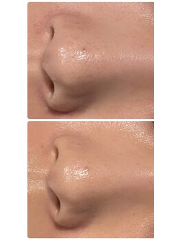 アルバ 広島店(ALBA)/【鼻の黒ずみ】水光毛穴洗浄