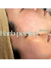 ティセ(TisseR)/ハード / 5回目