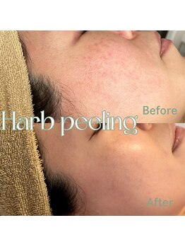 ティセ(TisseR)/ハード / 5回目