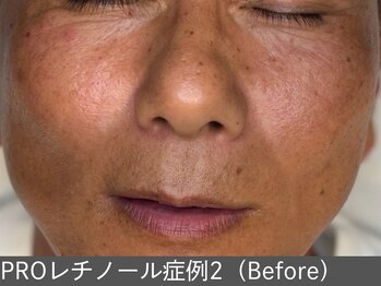オアシスラグーン(OASIS LAGOON)/レチノール(症例2 before)