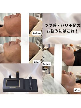 マウム(Maum)の写真/【韓国で大定番高密度超音波】マウム式ツヤ肌リフティングで憧れの水光肌へ☆細胞活性化＆土台ケア！