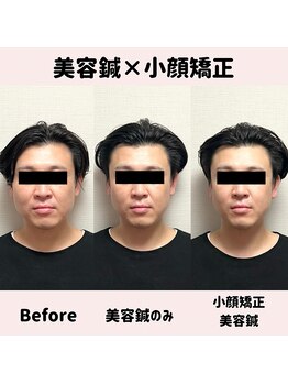 ワッカ 広尾(WACCA)/美容鍼×小顔矯正BeforeAfter 3