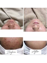 ビズビズ 梅田店(bisebise)/<症例>ニキビケア・跡・赤み