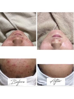 ビズビズ 梅田店(bisebise)/<症例>ニキビケア・跡・赤み