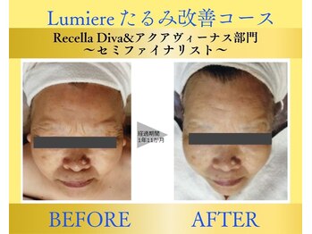 リュミエール(Lumiere)/【症例】シワたるみ改善コース