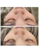 アークポノ(ark pono)/ハーブピーリング