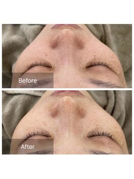 アークポノ(ark pono)/ハーブピーリング