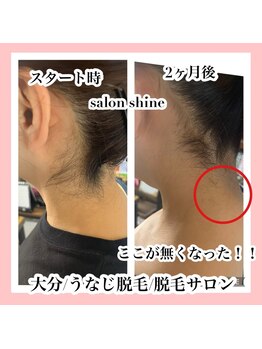 サロンシャイン(Salon Shine)/うなじ脱毛2か月放置