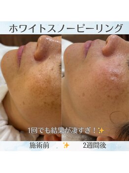 マリー エクラン/40代女性 シミケア