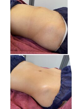 ルルン(LuLuN)/お腹くびら引き締めコース