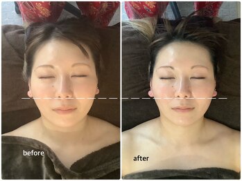 アベリア リュウ(Aberia Lieu)/頭蓋小顔矯正/小顔矯正